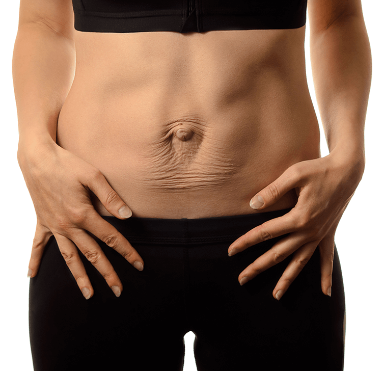 Understanding Diastasis Recti (DRA)