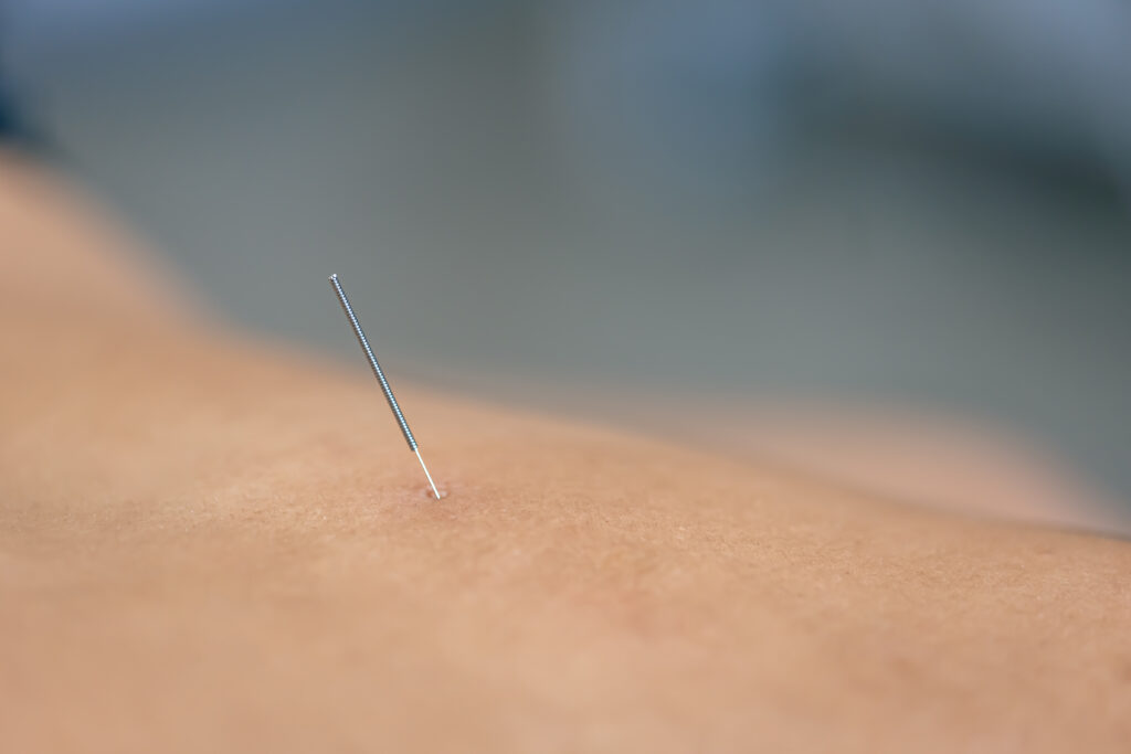 Dry needling