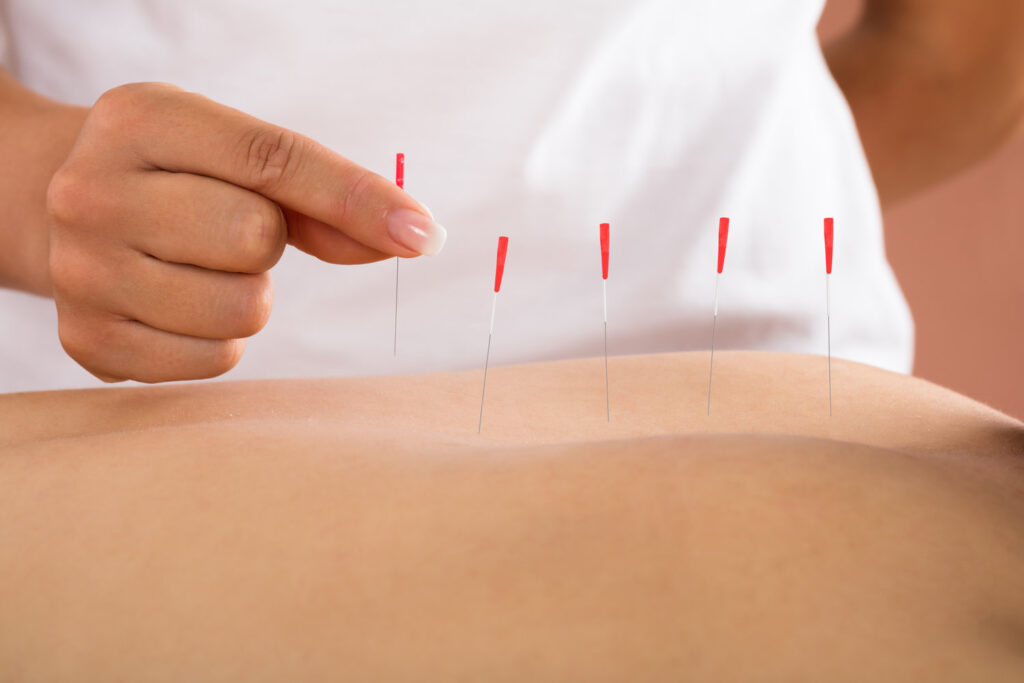 Dry Needling