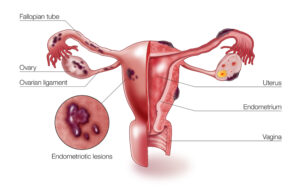 Endometriosis 