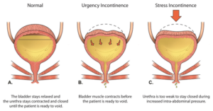 Overflow incontinence