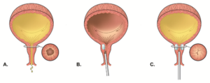 Urethral Bulking Agents