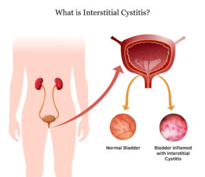 What Is Interstitial Cystitis/Bladder Pain Syndrome?